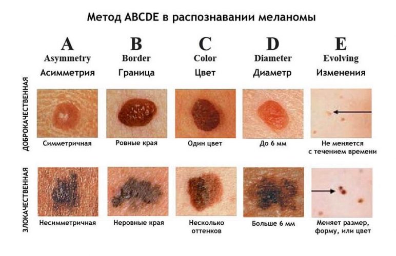 Меланома стопы: симптомы и лечение