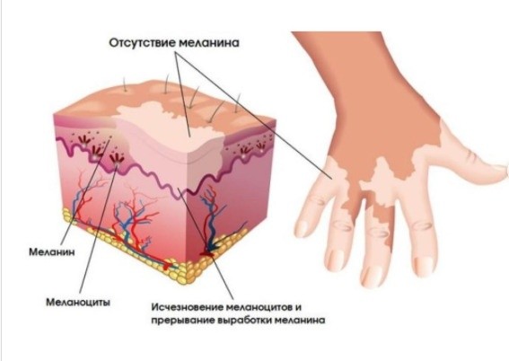 Витилиго у детей: причины и способы лечения